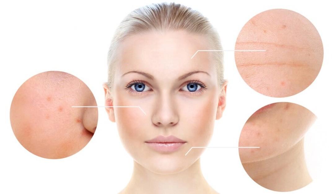 Are Chemical Peels Right for You? The Pros and Cons Explored