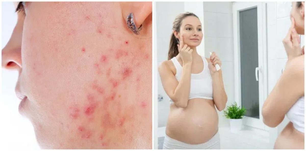 How to Take Care of Your Skin During Pregnancy