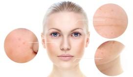 are-chemical-peels-r_1734599618780947043.webp