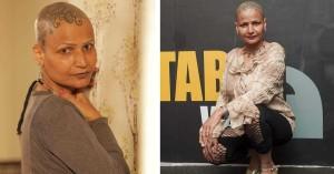living-with-alopecia_1742976389501329854.webp